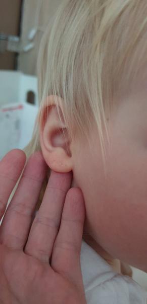 Fľaky na ušných lalokoch