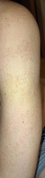 Z čoho môžu byť tieto kožné vyrážky?