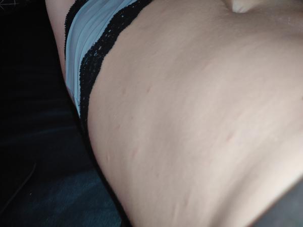 Aké červené fľaky mám na tele?