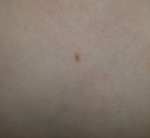 Poškrabané znamienko