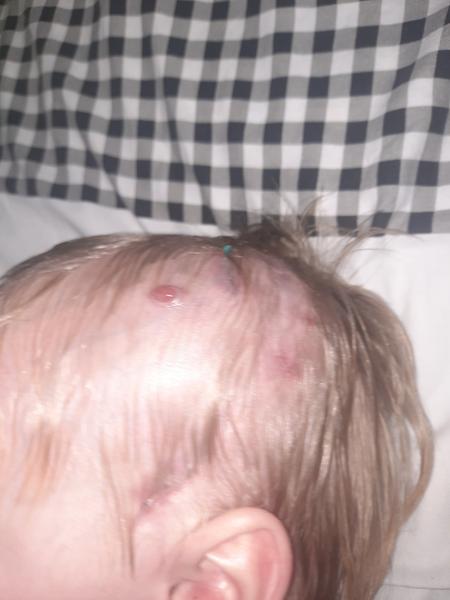 Ako riešiť kožný problém u dieťaťa po operácii?