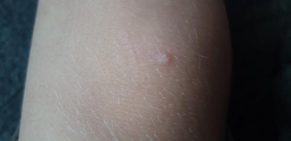 O aký kožný problém ide?