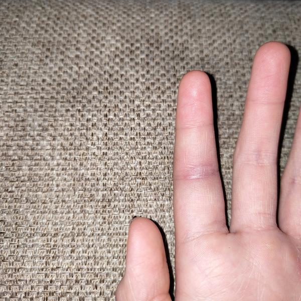 Je prst po náraze opuchnutý a zlomený?