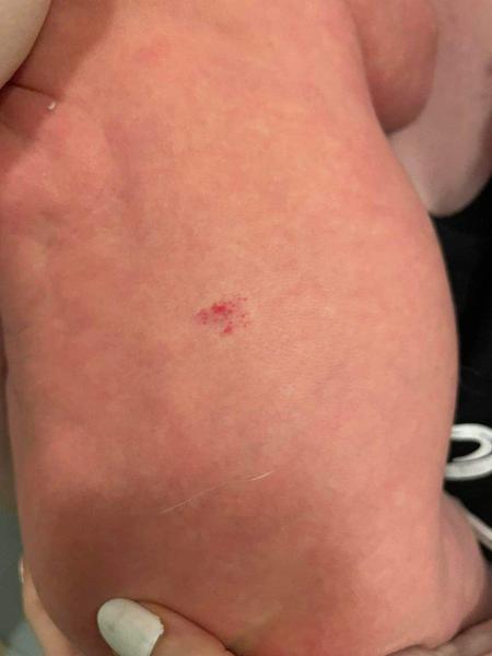 Je potrebné riešiť takýto hemangióm?