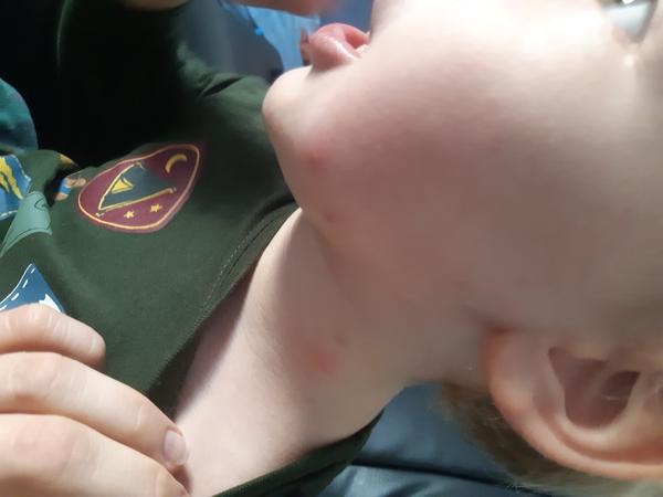 Aké vyrážky to má môj syn?