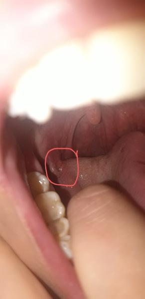 Ako postupovať pri liečbe jamky v ústach?