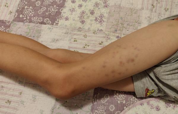 Modriny alebo ekzém u 7 ročného