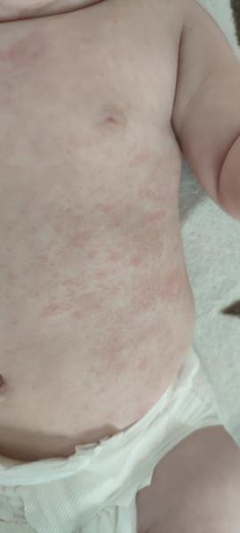 Aký výsyp má moja 5 mesačná dcérka po telíčku?