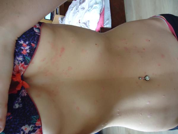 Ako som si vyliečila psoriázu