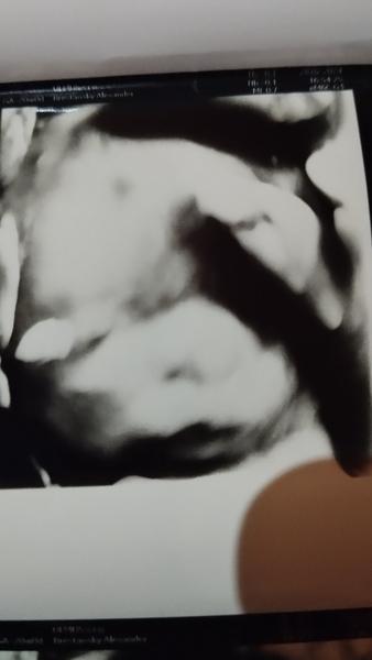 Skúsenosti s rázštepom pery u detí v tehotenstve