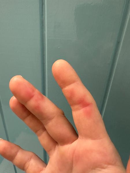 Môže sa u dospelého vyskytnúť siedma choroba?