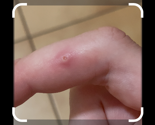 O aký kožný problém môže ísť?