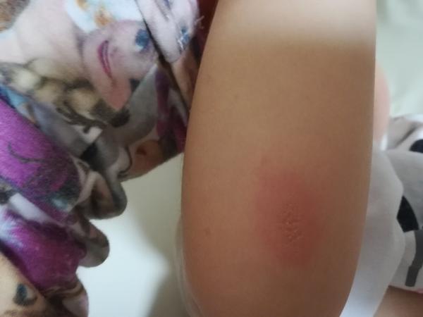 Aký problém znamená fľak na lakti?