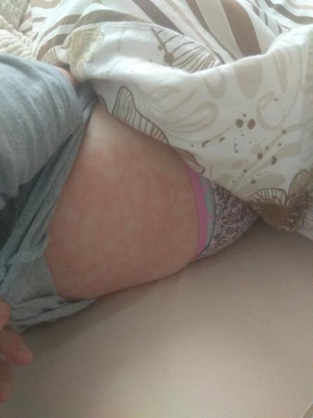 Vyrážky po celom tele dcérky, môže to byť alergia?