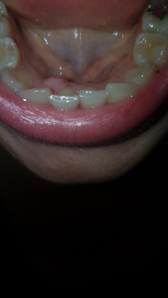 Výrastok v ústach. Rastie, pobolieva, stráca sa a zmenšuje. Čo to je?