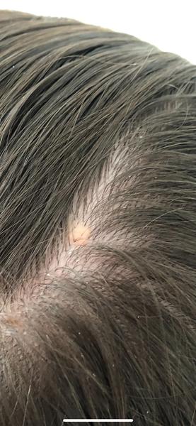 Mám to vo vlasoch šošovicu alebo bradavicu?