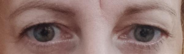 Je operácia horných viečok vhodná pre 45-ročnú ženu?