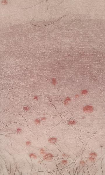 Čo spôsobuje vyrážky na podbrušku?