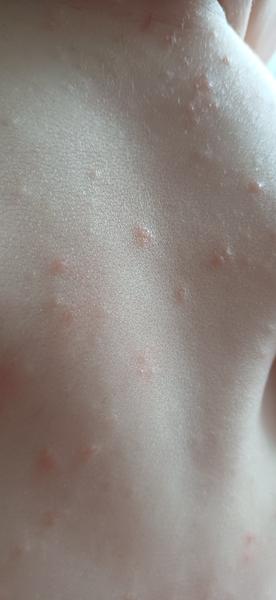 Vyrážky u dieťaťa po požití kravského mlieka?