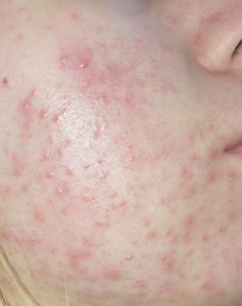 Ako sa účinne zbaviť problematického akné?