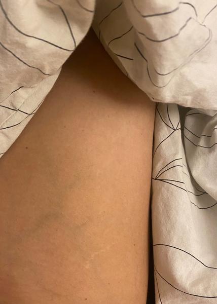 Viac viditeľné žily na jednej nohe. Čo to môže byť?