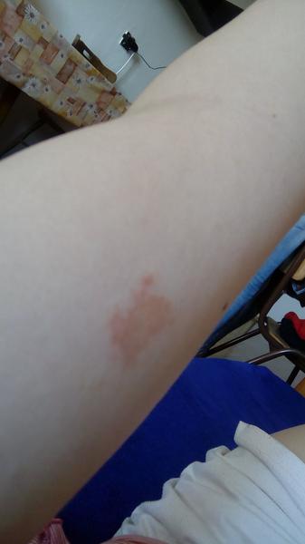 Červené fľaky na stehne