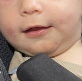 Ahojte,prosím máte niekto skúsenosť s podráždením v tejto oblasti u bábätka?zabralo vám niečo na to?…7 mesiacov,UM,príkrmy na to zrejme nemajú vplyv…ďakujem
