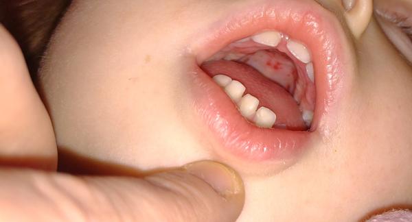 Červené vyrážky na podnebí