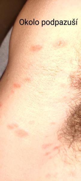 Vyrážky okolo slabín a podpazuší