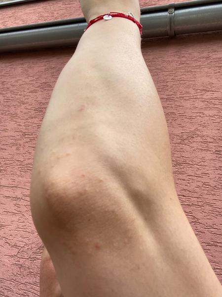 Vyrážky na lakťoch