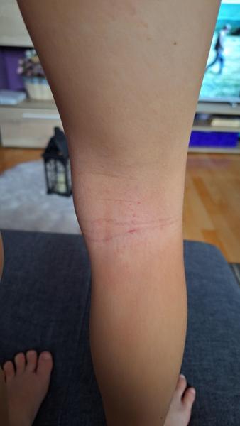 Pomoc pri svrbení a suchej pokožke u detí