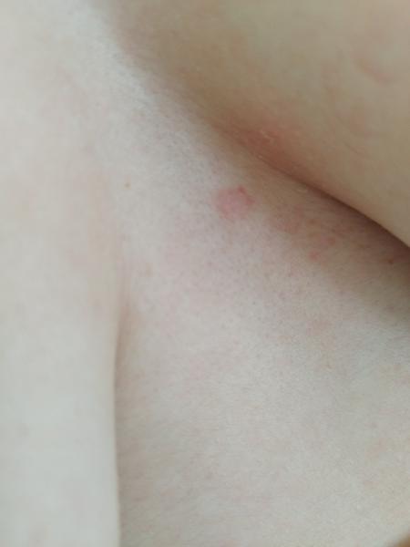 Čo robiť s vyrážkou medzi prsiami?