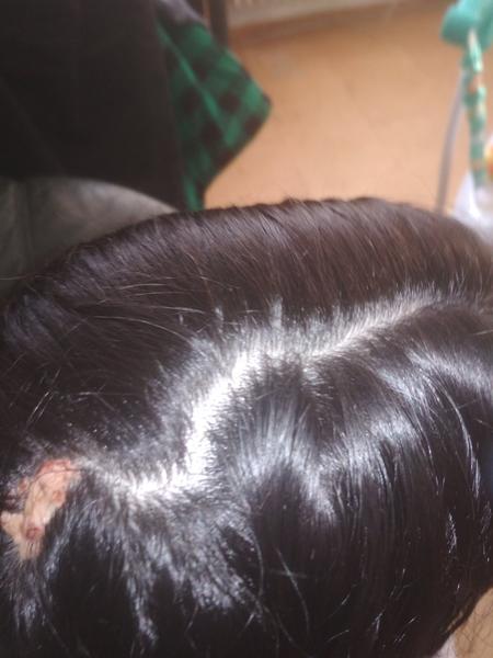 Nevus mazových žliaz: Ako ho odstrániť?