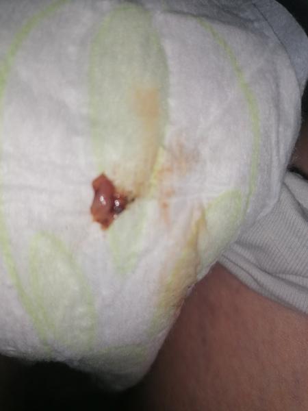 Som v 30. týždni a našla som si hlien s krvou