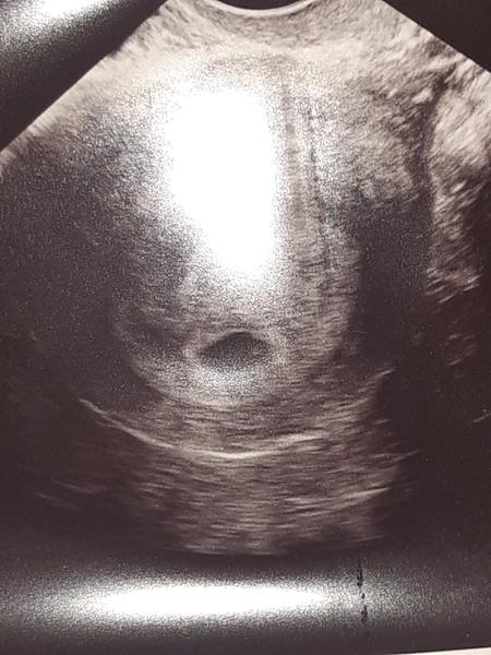 Vidím dva vaky. Čakám dvojčatá?