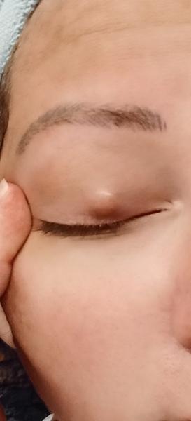 Ako liečiť jačmeň v oku a čo očakávať?