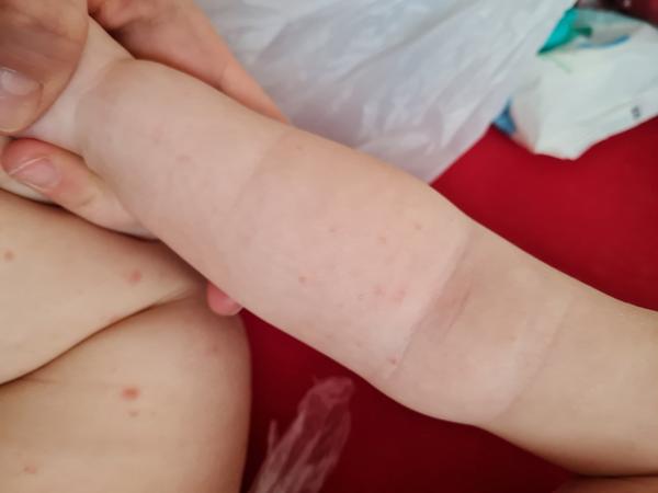 Je to siedma choroba alebo kiahne?