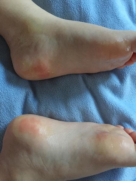 Červené fľaky na chodidlách