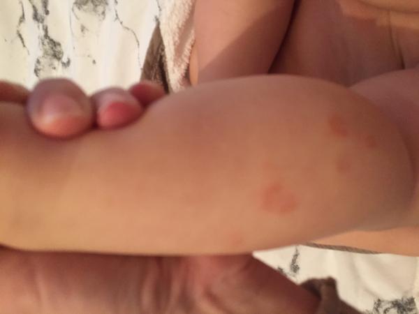 Je to podľa vás ekzém?