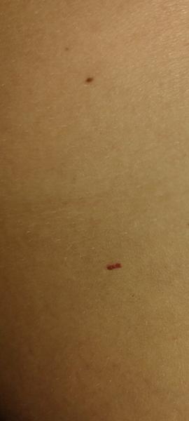 S mužom máme malé hryzance. Môžu to byť ploštice?