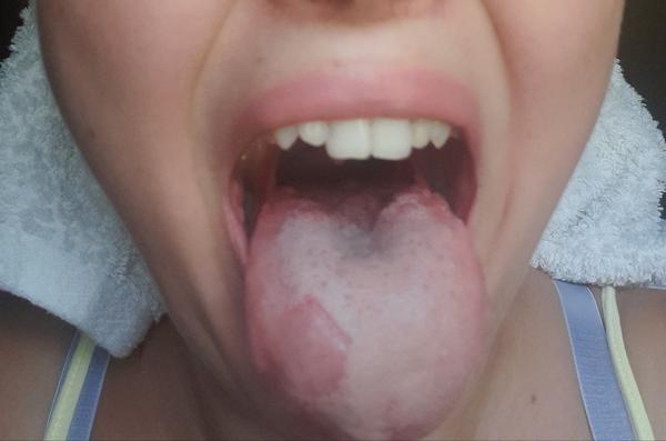 Zvláštne škvrny na jazyku