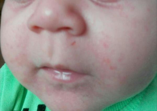 Aké vyrážky má môj 10 mesačný syn na tvári?
