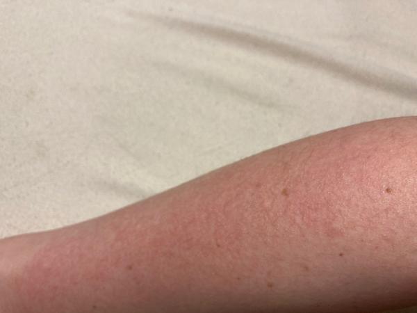 Aký výsyp mám na ruke?