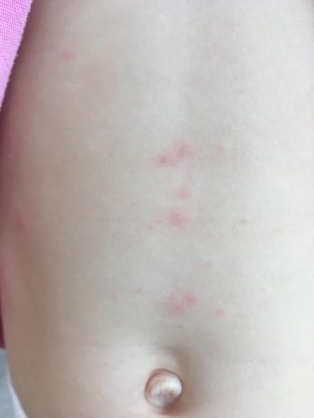 Čo sú to za vyrážky?