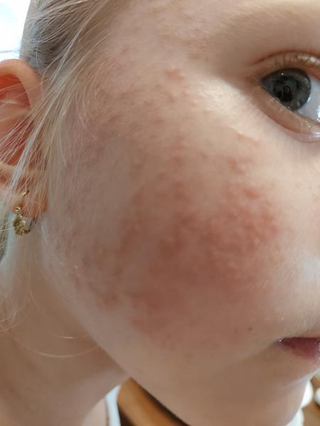 Vyrážky na lícach 5 ročnej dcéry