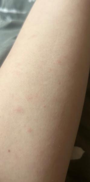 Vyrážky na predlaktí