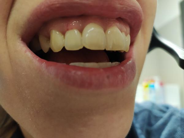 Červené bodky a bolesť pri umývaní zubov