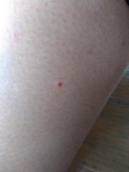 Mám ísť s červeným znamienkom na lýtku k lekárovi?