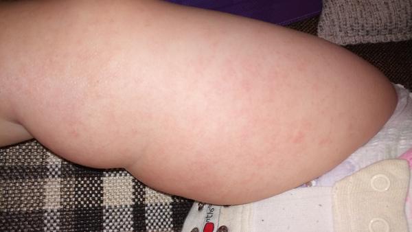 Má moja dvojročná dcérka ekzém, alebo reakciu na perkarbonát sodný?