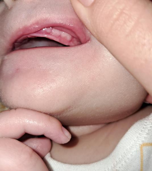 3-mesačné bábätko: Prečo stále plače a má horúčku?